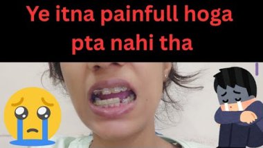My braces timelaps video 2 || varsha daily vlogs