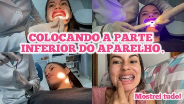 Em fim coloquei a parte inferior do aparelho ortodôntico / Mostrei tudo.