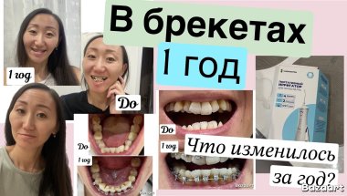1 ГОД В БРЕКЕТАХ😁 ЗЫБЫ РОВНЫЕ😬 ПРИКУС СТАЛ ХУЖЕ😱 СРАВНИМ ДО И ПОСЛЕ