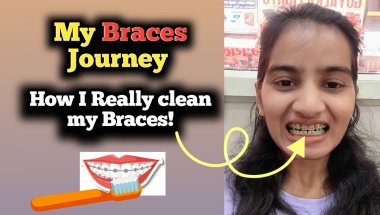 This Is How I Clean My Braces! 😁