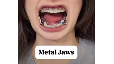 Media 'Herbst Orthodontic Appliance' in category 'Herbst Appliance'