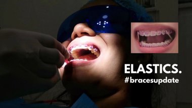 #BracesUpdate🦷: CLASS 2 ELASTICS + ADJUSTMENT