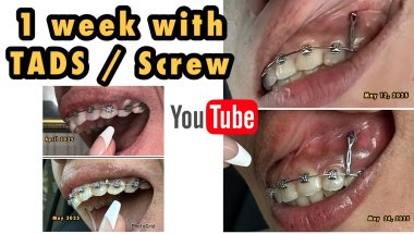 1 week result & experience wearing TADS / Screw Braces