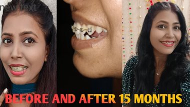 15 Months Braces Transformation || BEFORE & AFTER !😊 Adult Braces || Nd Family Vlogs