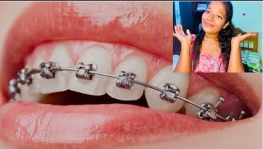 പല്ലിൽ🦷😬 കമ്പി ഇടുമ്പോഴുള്ള ബുദ്ധിമുട്ടുകൾ|Teeth braces problems|Malluz express