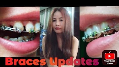 26th months braces updates2025,May || change Powerchain || nurse #bracesupdates #adultsbraces