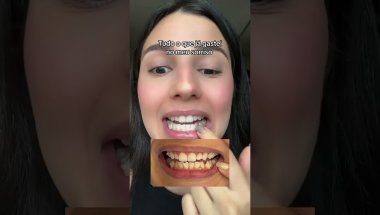 Quanto custa o aparelho invisível da Sousmile? #aparelhoinvisivel #sousmile CUPOM: FENIX