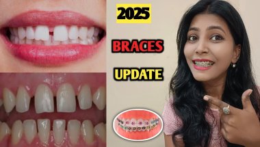 My Braces Journey😊 || Braces Update || Teeth clip Treatment ||Nd Family Vlogs