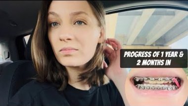 14 Months Braces Appointment + Supposed to be Getting My 2nd X-Ray
