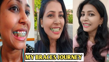 MY BRACES JOURNEY || BEFORE AND AFTER #braces #bracesjourney #Transformationvideo #bracesvlog #vlog