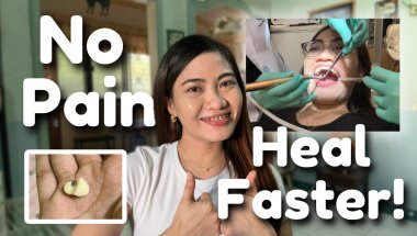 Wisdom teeth extractions recovery tips (how to heal faster)