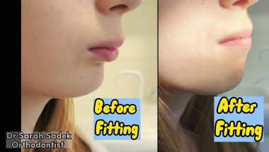 Twin Block Braces Fitting Appointment - Before & After