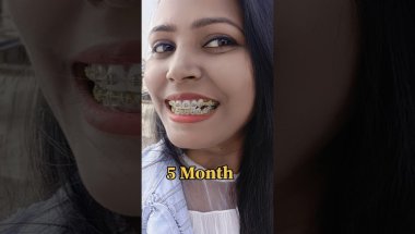 Braces journey Before & After #braces #bracesjourney #shorts #viralshorts   #bracesbeforeandafter
