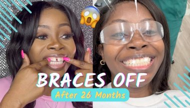 Braces Off After 26 Months: Final Results & Raw Reaction! | Just Wideline