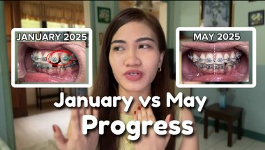 May Braces Updates || Improvements for the past 5 months
