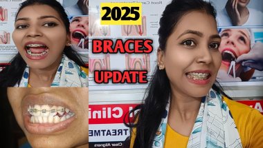 My Braces Journey | Braces Update | Nd Family Vlogs #braces #bracesjourney