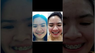 PA ADJUST NG BRACE SA BGC