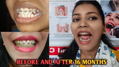 My Braces Transformation Journey/ BEFORE & AFTER TRANSFORMATION VIDEO #braces #bracesjourney