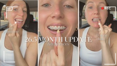 26.5 Month Adult Braces Update | Almost Done?! 😬✨
