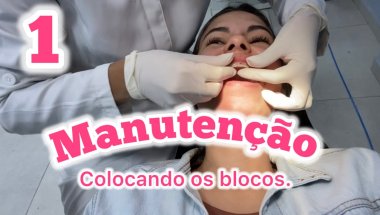 1ª manutenção do aparelho ortodôntico, colocando os blocos.