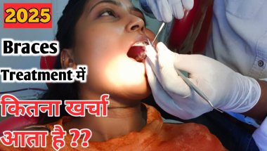 Braces Cost in india | Braces Cost 2025 | Types Of Braces | #bracescost #braces #bracesupdate