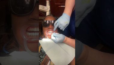 Yay 😁 I picked up my Invisalign 🦷 #invisaligndentist