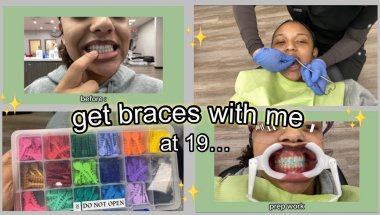 COME GET BRACES WITH ME ! (experience + pain level)