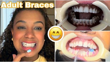 Getting Braces as a Married Couple