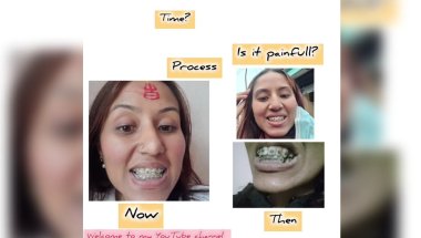 Braces? Omg😱 I regretted. Struggle of people with  braces. BRACES JOURNEY #trending #viral #nepal