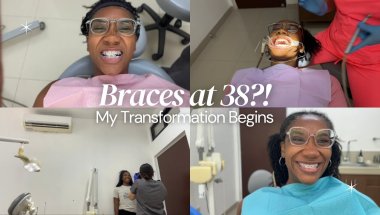 Braces Journey: Braces at 38 | My transformation begins | Life in Mexico