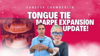 Tongue Tie + MARPE Expansion Update