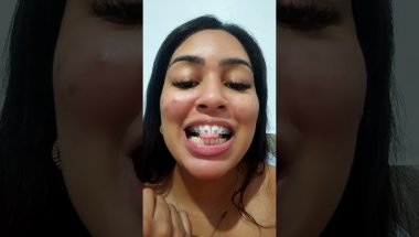Três semanas de aparelho autoligado.
