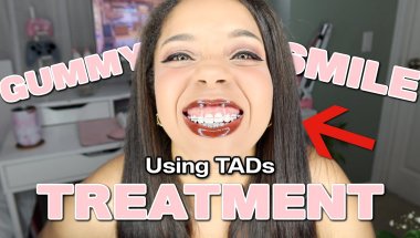 Gummy Smile Treatment! TADs for GUMMY SMILE BRACES Vlog ✧ Before & After + My Experience!