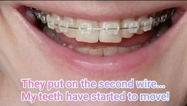 Fear of wiggly teeth 😱🦷#braces #orthodontics #teeth
