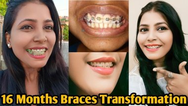 My Braces Journey  |16 Months Braces Transformation | Adult Braces Before And After #bracesjourney