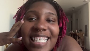 Braces at 35!