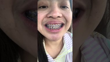 Purple rubber on my braces done chosenbydental aid|| on my 1st adjustment #canada #vlog #motivation