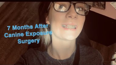 15 Month Braces Appointment | Major Update/Change