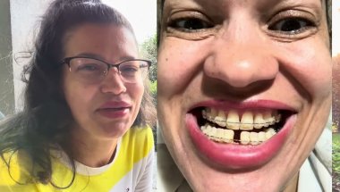 SAGA DO APARELHO DENTÁRIO  PARTE 3 - 3 SEMANAS DE TRATAMENTO