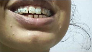 First day with braces   #bracestransformation #ciramic #braces
