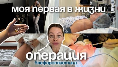 СДЕЛАЛА БЛЕФАРОПАСТИКУ В 25 ЛЕТ | ДО ПОСЛЕ