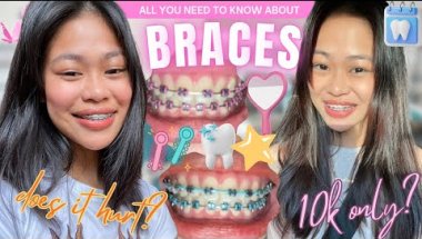 Braces for Beginners‼️🦷 Does It Hurt? Cost & Best Colors 💸✨️