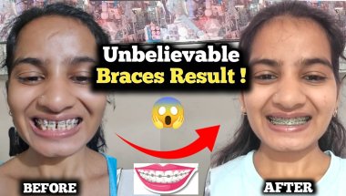 My 8 Months Braces Journey | From Insecure to Confident 😁