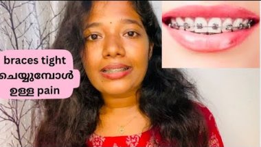 braces tight ചെയ്യുമ്പോൾ ഉള്ള pain 😱🙂