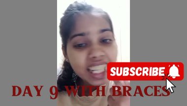 Let's break the myths about braces #braces #braceslife #bracestreatment #facts