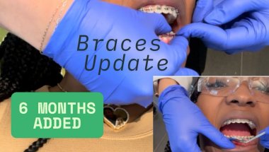 Braces Update: I have to restart my lower braces progress ADDS 6 MORE MONTHS