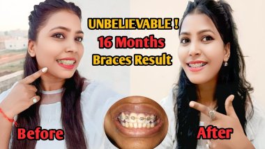 16 Months Braces Transformation | BEFORE & AFTER 😱 Nd Family Vlogs