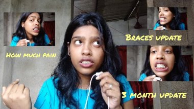 My Braces update#braces #vlog #story