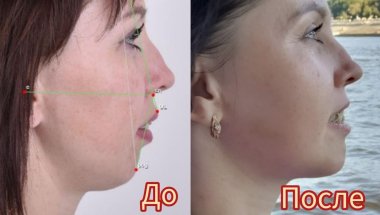 #22 Сняли сплинт. 8 недель после ортогнатии. Учусь кушать.