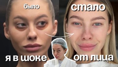 Прошло 5 дней после блефаро — я в шоке от своего лица